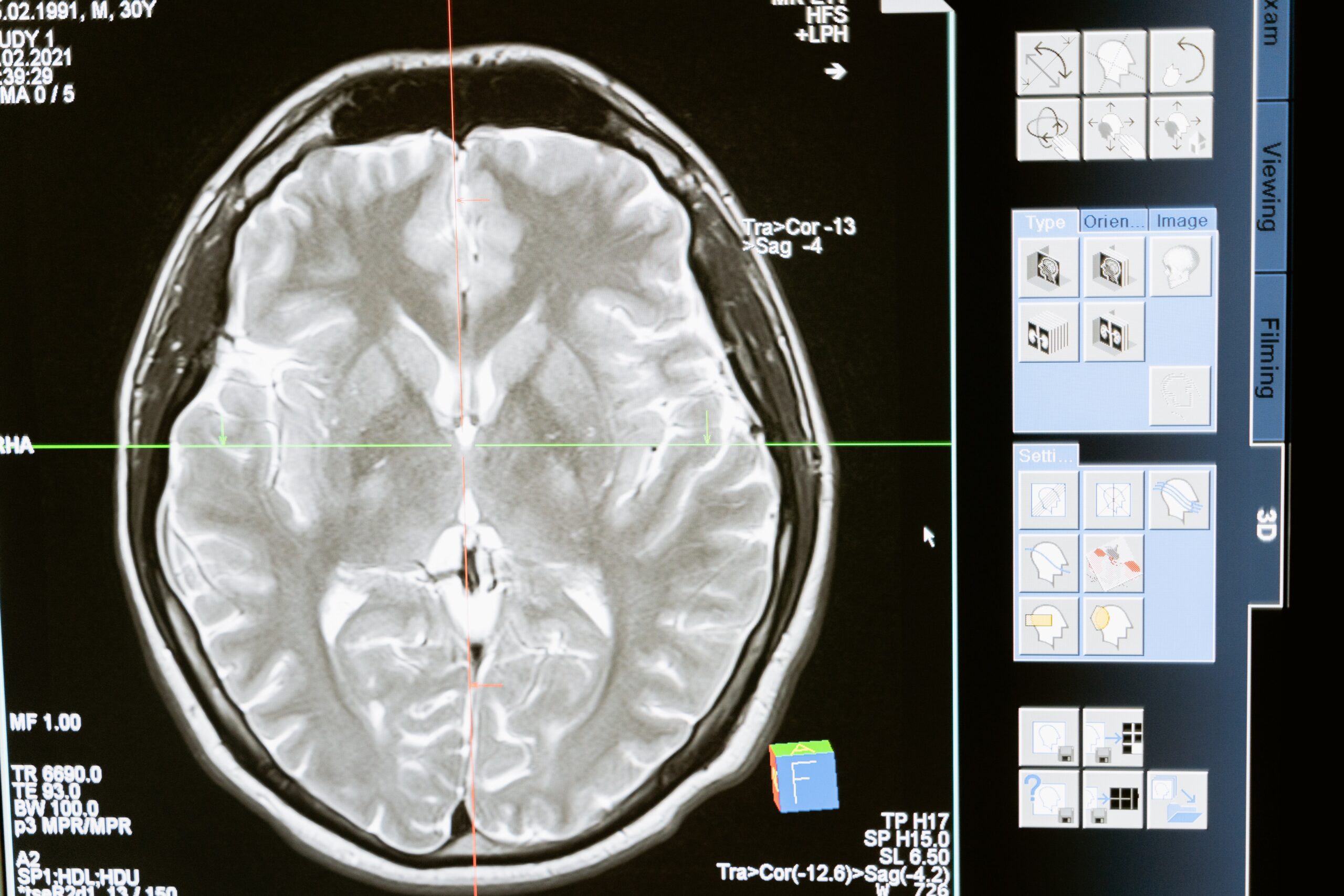 Obésité Cerveau
